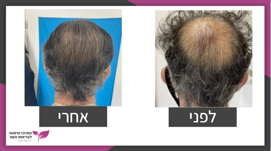 השתלת שיער סינתטי