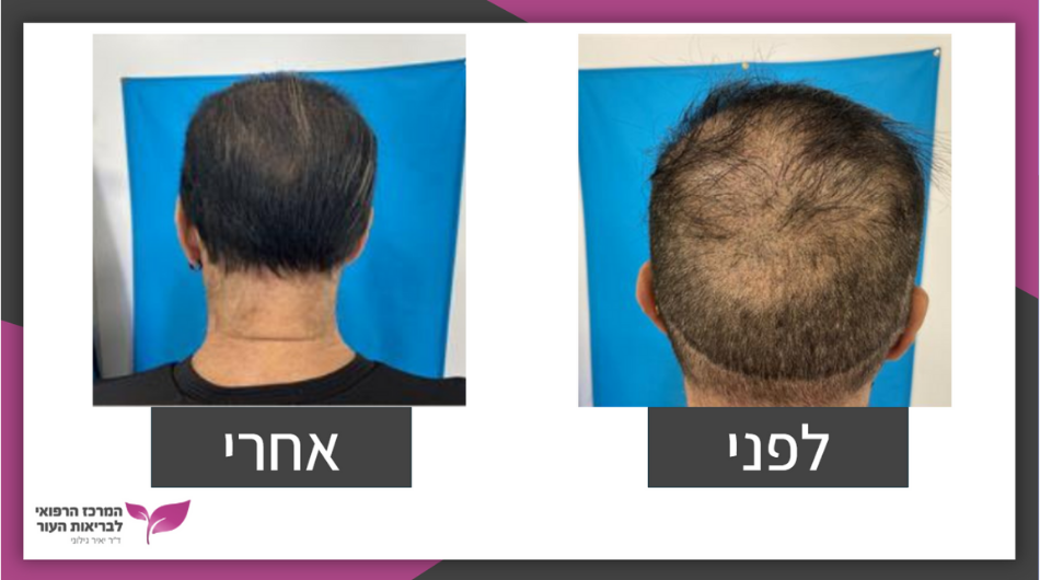 השתלת שיער סינתטי