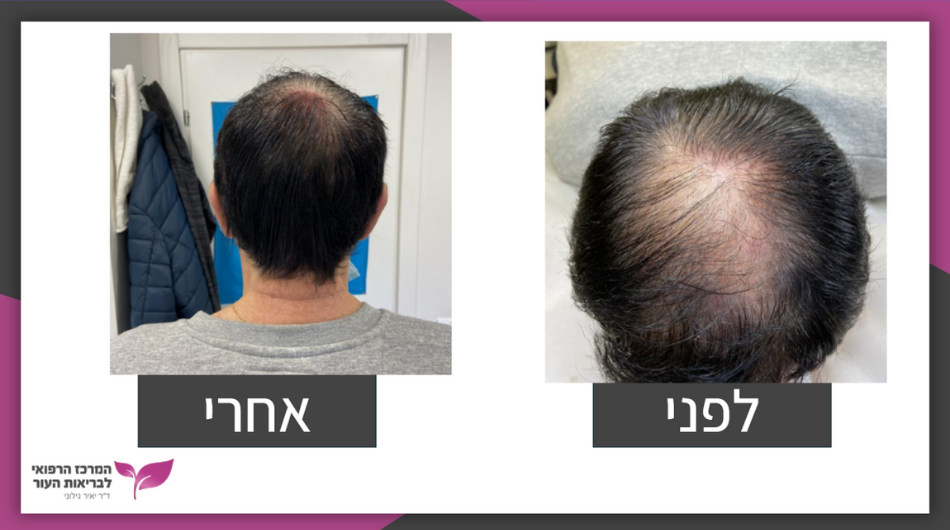 השתלת שיער סינתטי